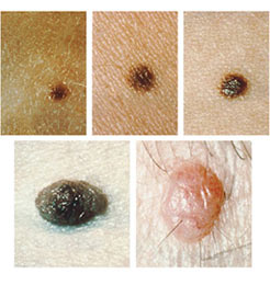common-moles-article.jpg